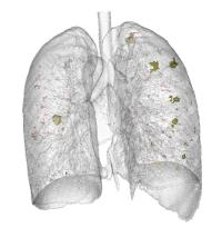 Nodule missed by radiologist but detected by a computer